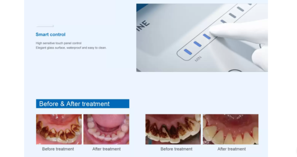 PT7 Periodontal Treatment-Device 1780-3 Détartreur ultrasonique REFINE PT7 avec irrigation – Scaler dentaire